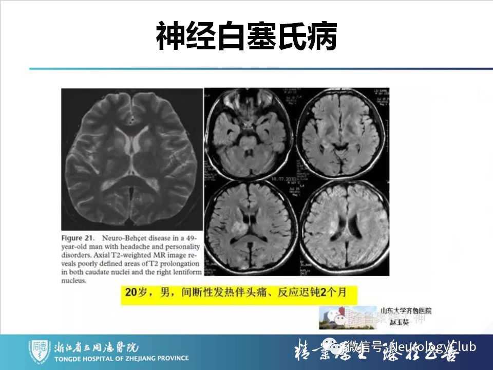 影像PPT - 【PPT】双侧基底节病变的影像诊断和鉴别诊断-137