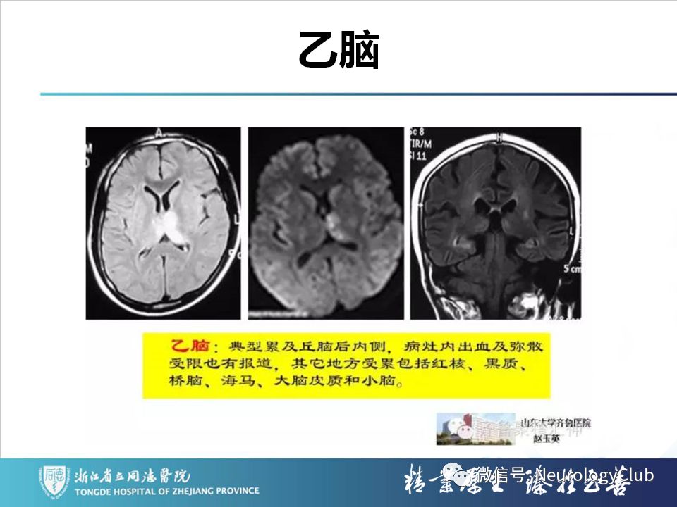影像PPT - 【PPT】双侧基底节病变的影像诊断和鉴别诊断-140