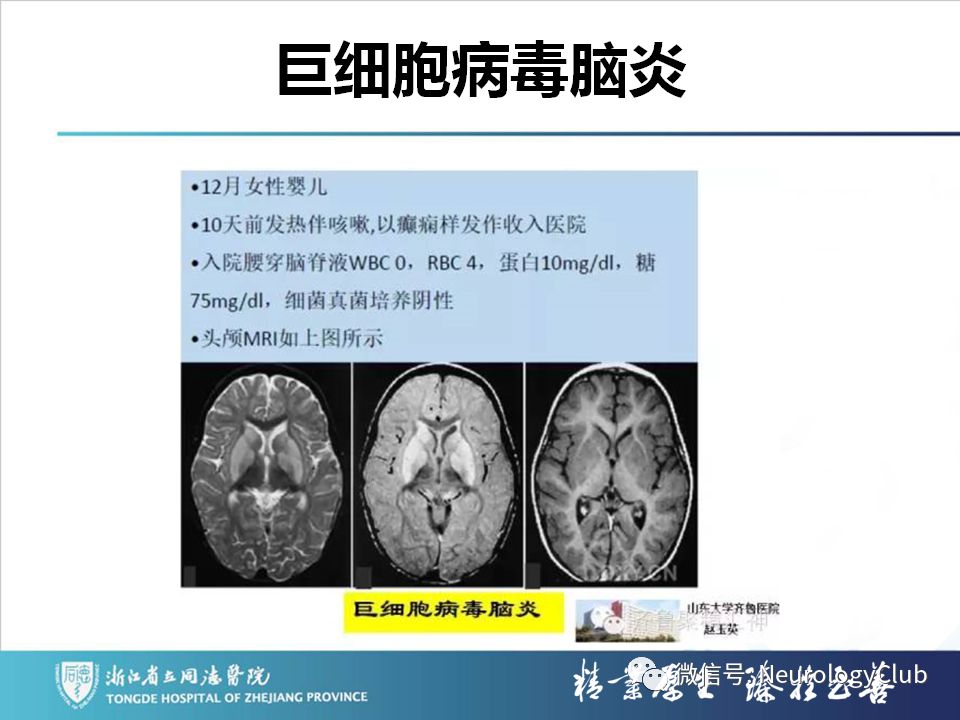 影像PPT - 【PPT】双侧基底节病变的影像诊断和鉴别诊断-141