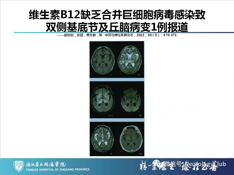 影像PPT - 【PPT】双侧基底节病变的影像诊断和鉴别诊断-142