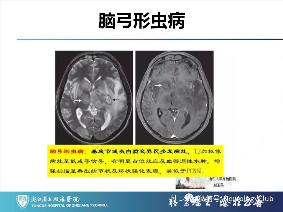 影像PPT - 【PPT】双侧基底节病变的影像诊断和鉴别诊断-143