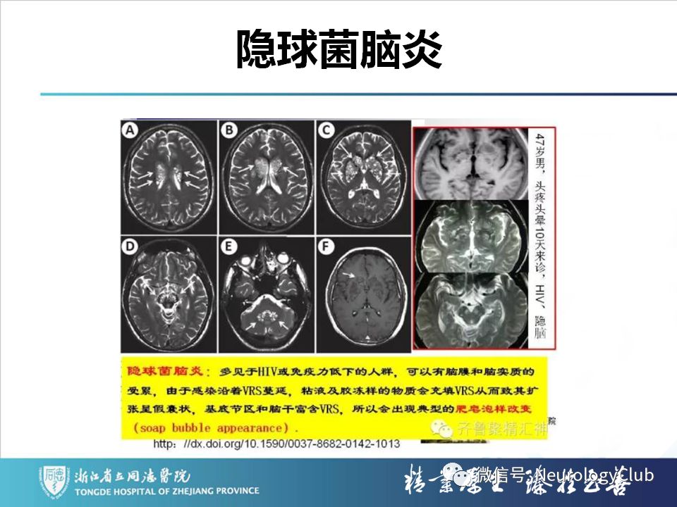 影像PPT - 【PPT】双侧基底节病变的影像诊断和鉴别诊断-145