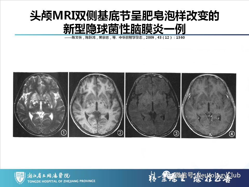 影像PPT - 【PPT】双侧基底节病变的影像诊断和鉴别诊断-146