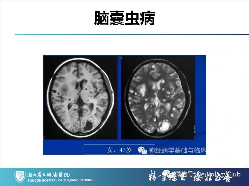 影像PPT - 【PPT】双侧基底节病变的影像诊断和鉴别诊断-147
