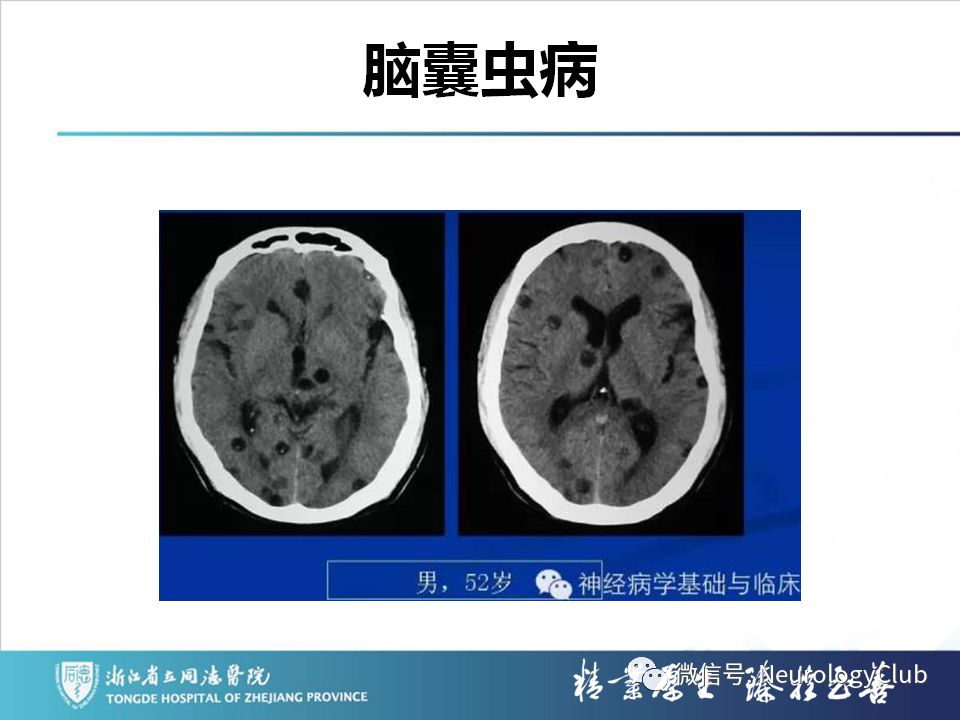 影像PPT - 【PPT】双侧基底节病变的影像诊断和鉴别诊断-148
