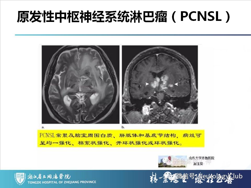 影像PPT - 【PPT】双侧基底节病变的影像诊断和鉴别诊断-151