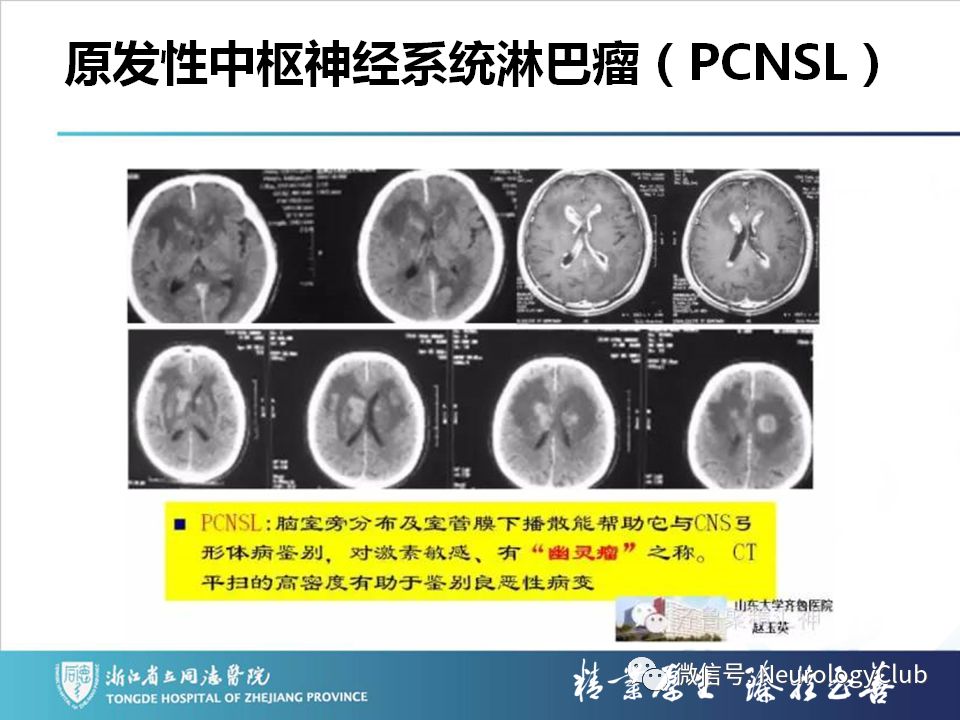 影像PPT - 【PPT】双侧基底节病变的影像诊断和鉴别诊断-152