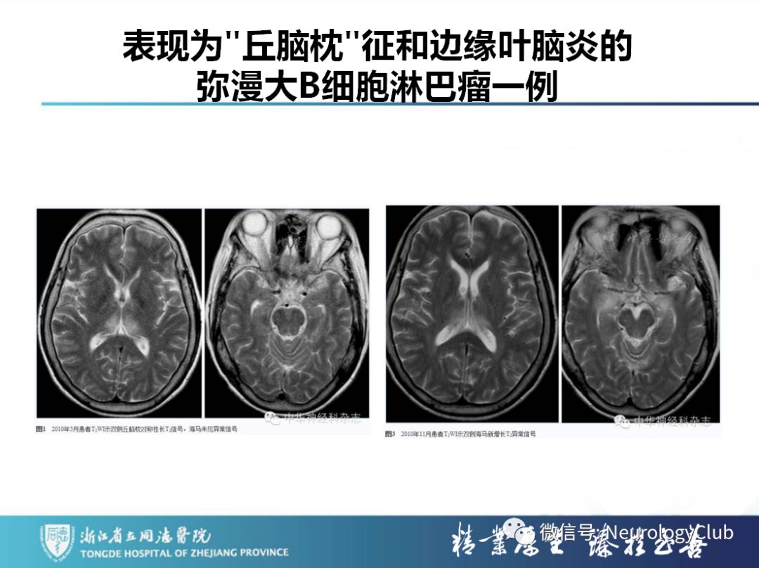 影像PPT - 【PPT】双侧基底节病变的影像诊断和鉴别诊断-153