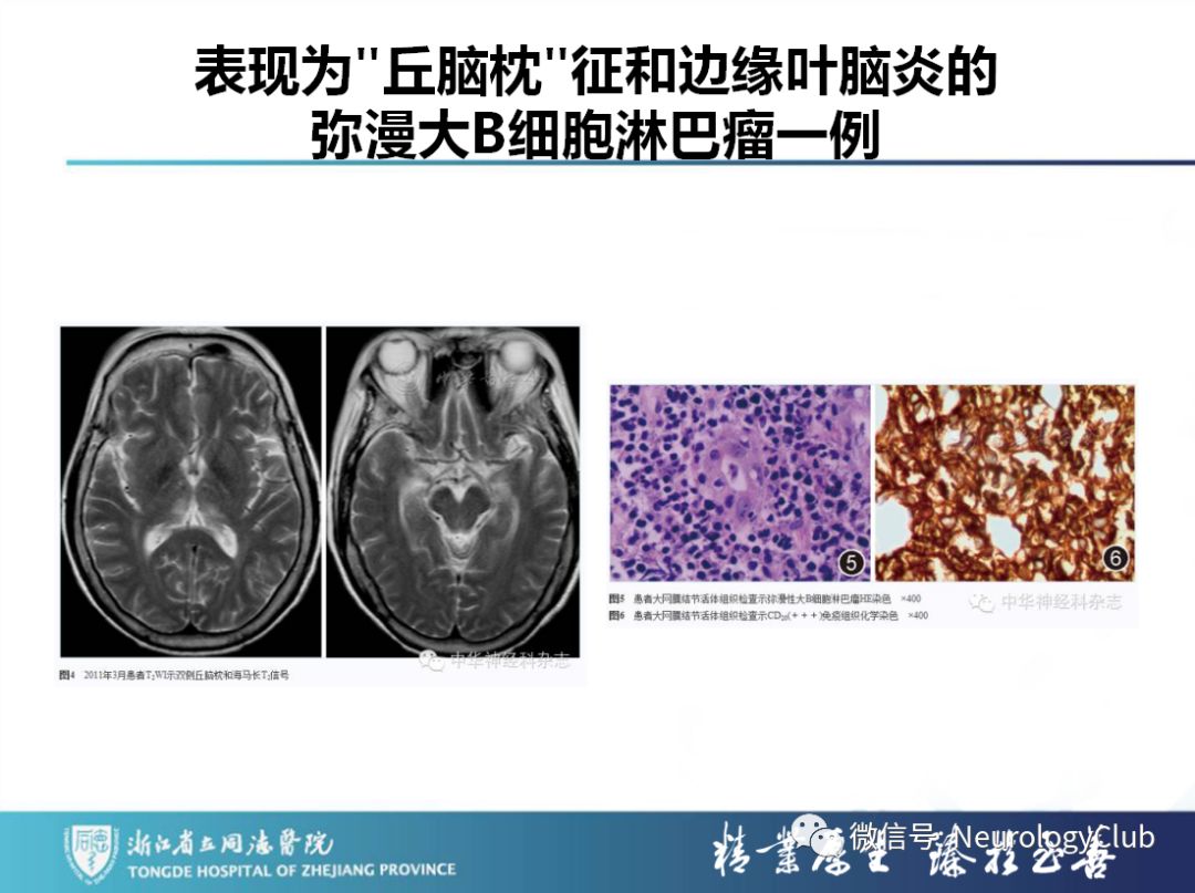 影像PPT - 【PPT】双侧基底节病变的影像诊断和鉴别诊断-154