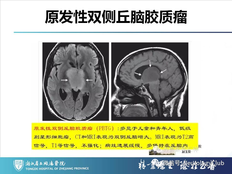 影像PPT - 【PPT】双侧基底节病变的影像诊断和鉴别诊断-155