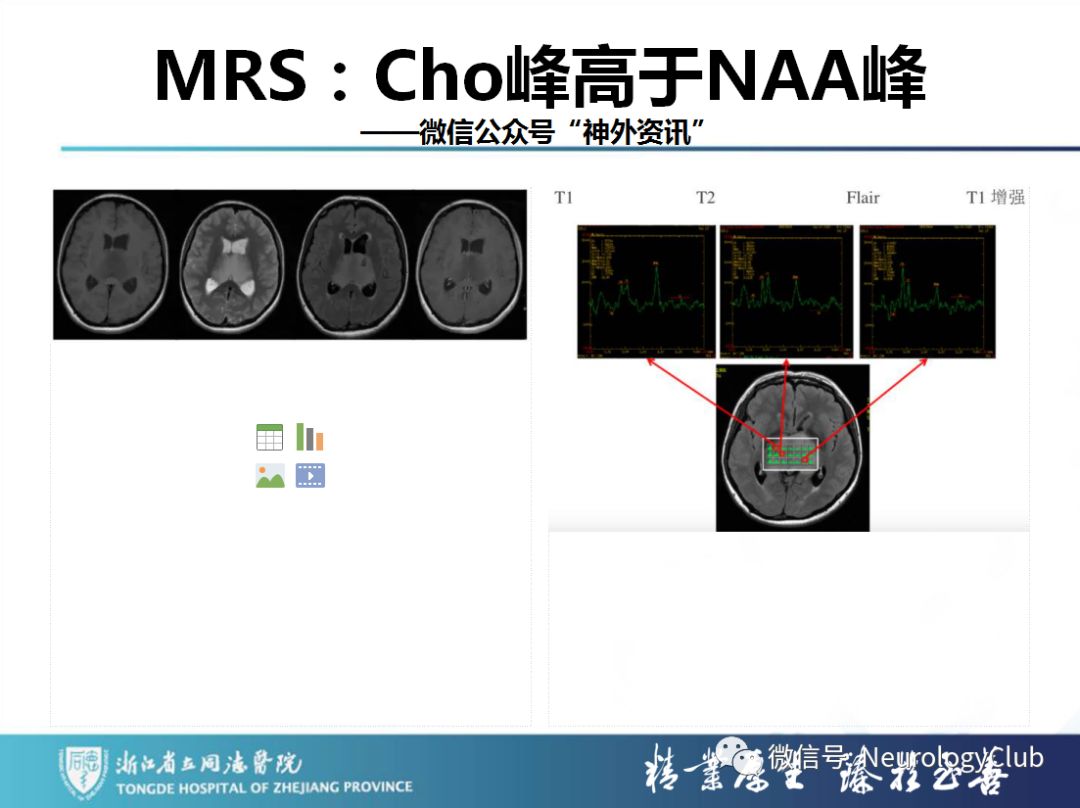影像PPT - 【PPT】双侧基底节病变的影像诊断和鉴别诊断-157