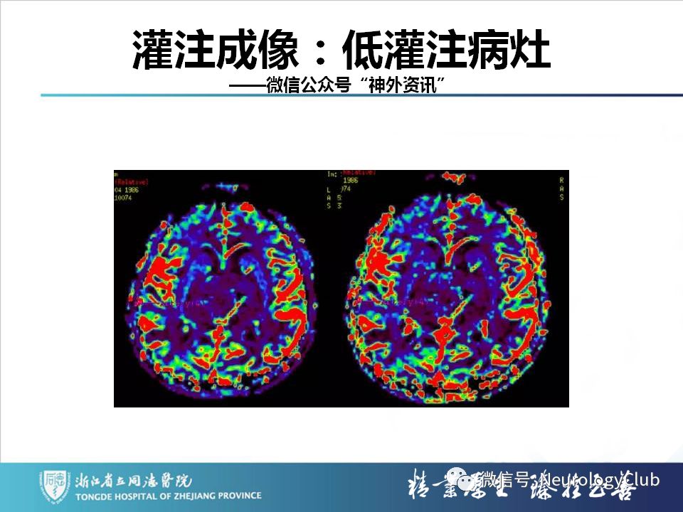 影像PPT - 【PPT】双侧基底节病变的影像诊断和鉴别诊断-158
