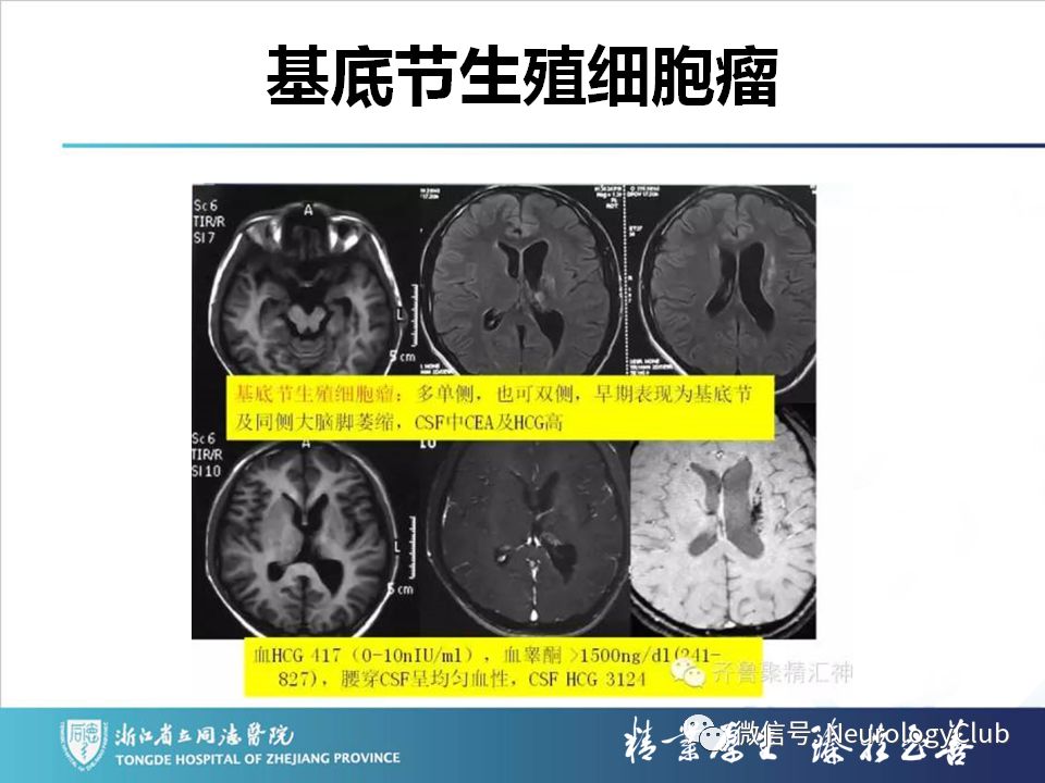 影像PPT - 【PPT】双侧基底节病变的影像诊断和鉴别诊断-160