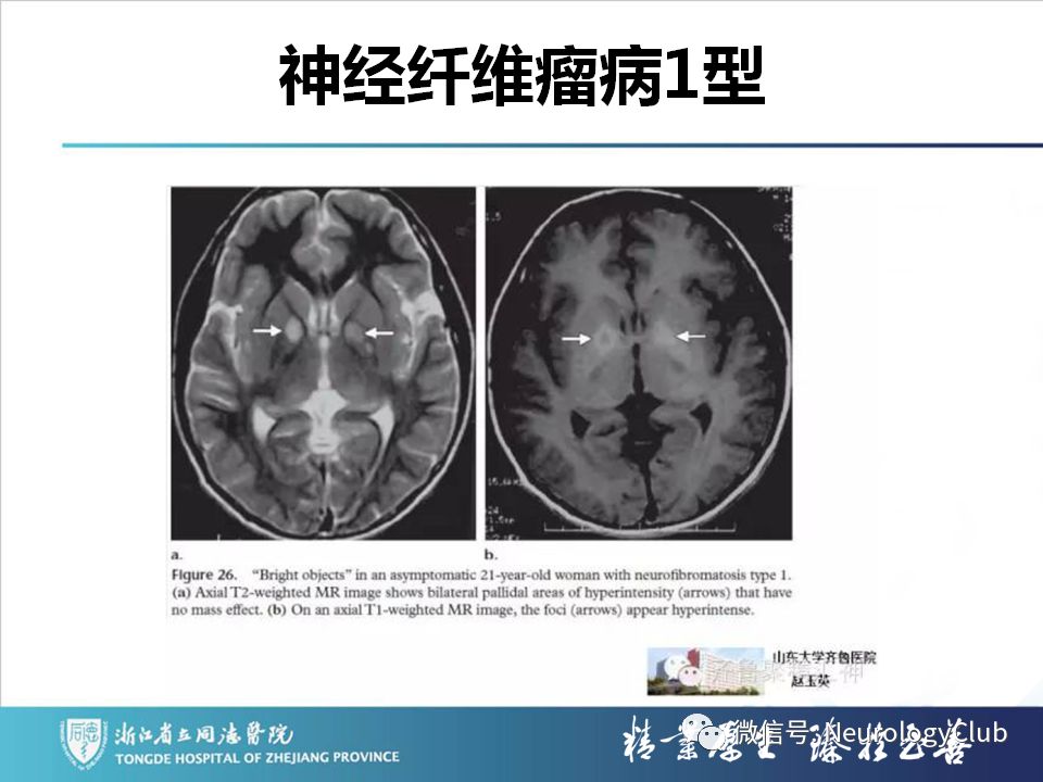 影像PPT - 【PPT】双侧基底节病变的影像诊断和鉴别诊断-163