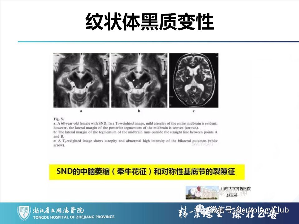 影像PPT - 【PPT】双侧基底节病变的影像诊断和鉴别诊断-168