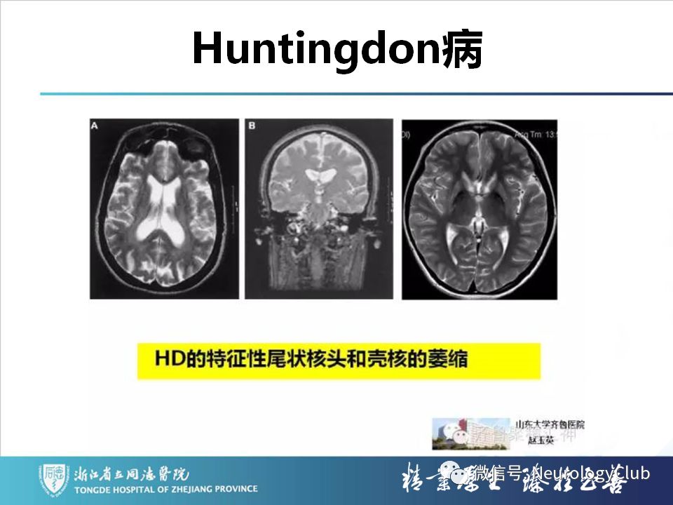 影像PPT - 【PPT】双侧基底节病变的影像诊断和鉴别诊断-167