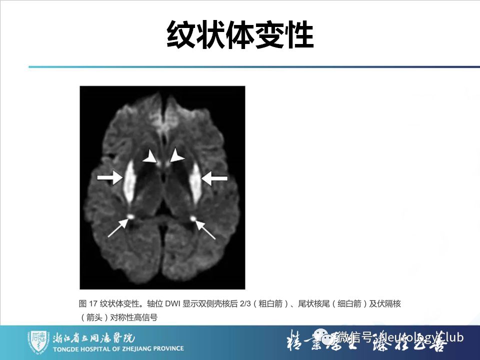 影像PPT - 【PPT】双侧基底节病变的影像诊断和鉴别诊断-169