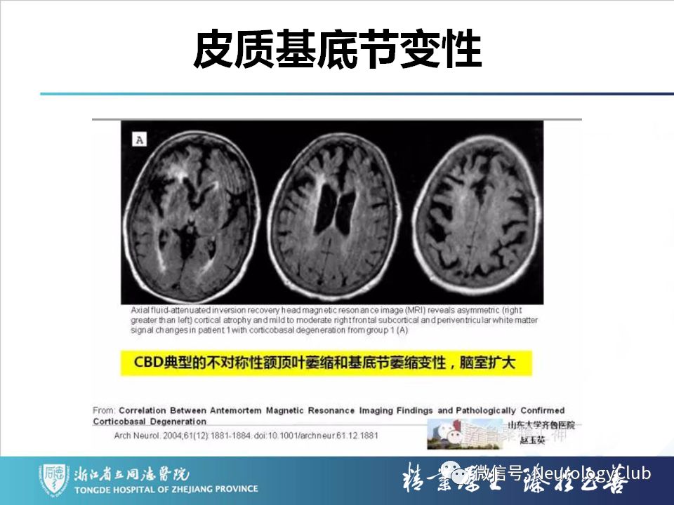 影像PPT - 【PPT】双侧基底节病变的影像诊断和鉴别诊断-170