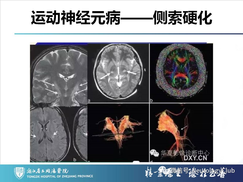 影像PPT - 【PPT】双侧基底节病变的影像诊断和鉴别诊断-171
