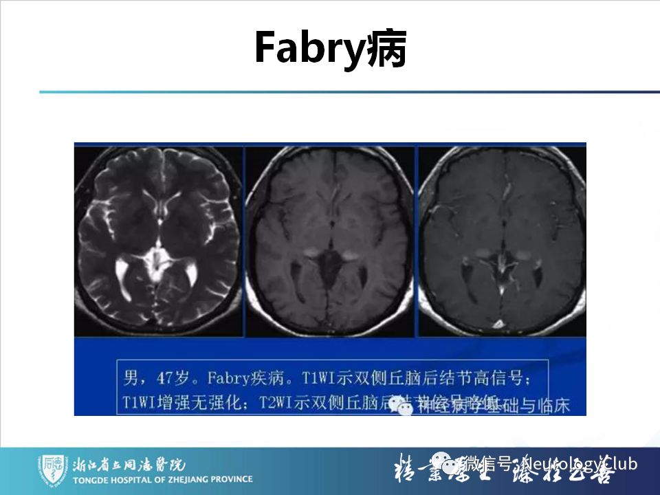 影像PPT - 【PPT】双侧基底节病变的影像诊断和鉴别诊断-174