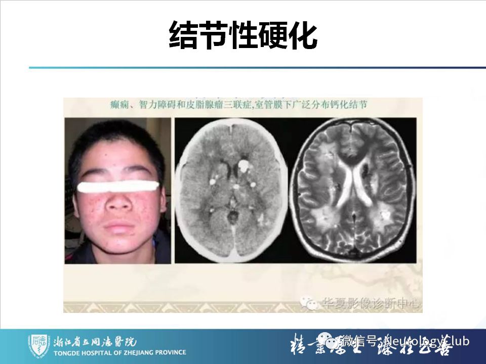 影像PPT - 【PPT】双侧基底节病变的影像诊断和鉴别诊断-175
