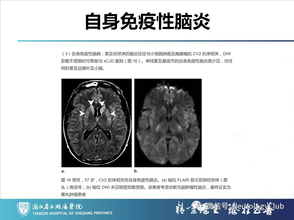 影像PPT - 【PPT】双侧基底节病变的影像诊断和鉴别诊断-177