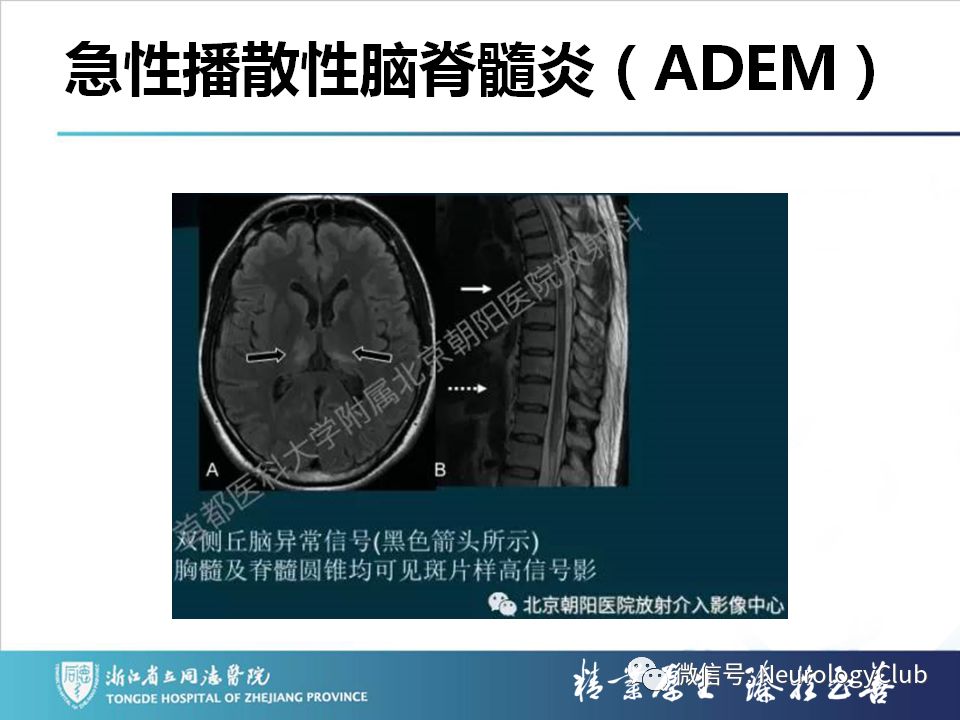影像PPT - 【PPT】双侧基底节病变的影像诊断和鉴别诊断-179