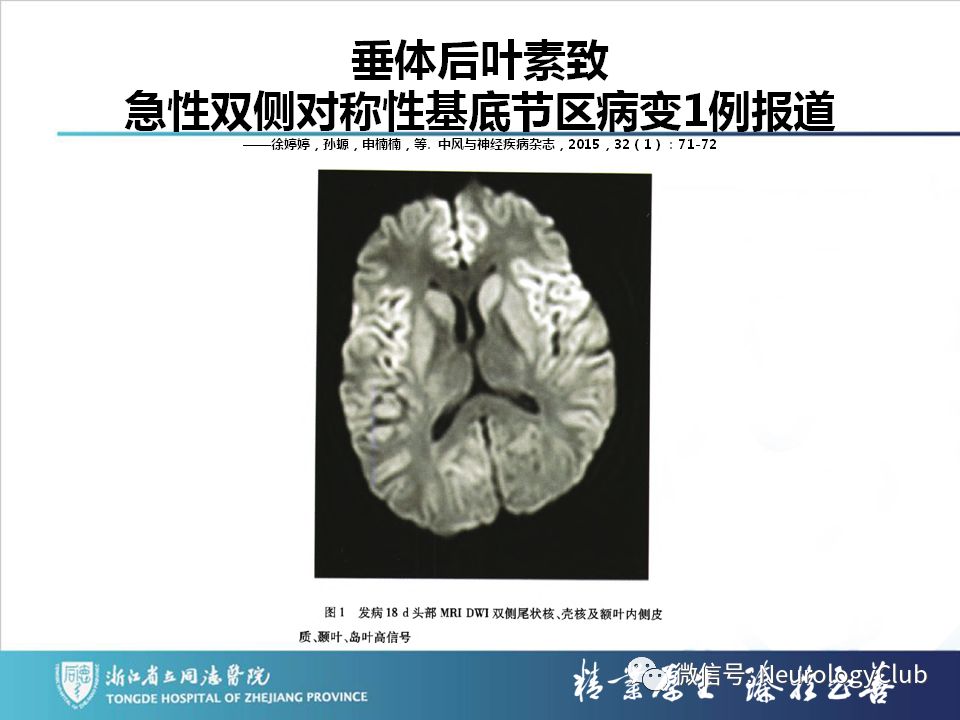 影像PPT - 【PPT】双侧基底节病变的影像诊断和鉴别诊断-181