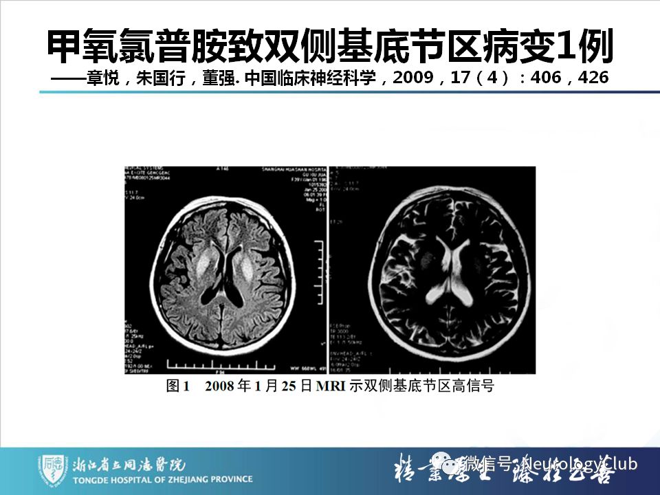 影像PPT - 【PPT】双侧基底节病变的影像诊断和鉴别诊断-182