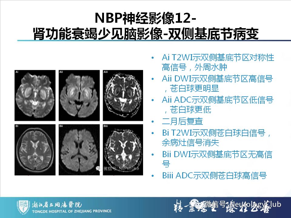 影像PPT - 【PPT】双侧基底节病变的影像诊断和鉴别诊断-185