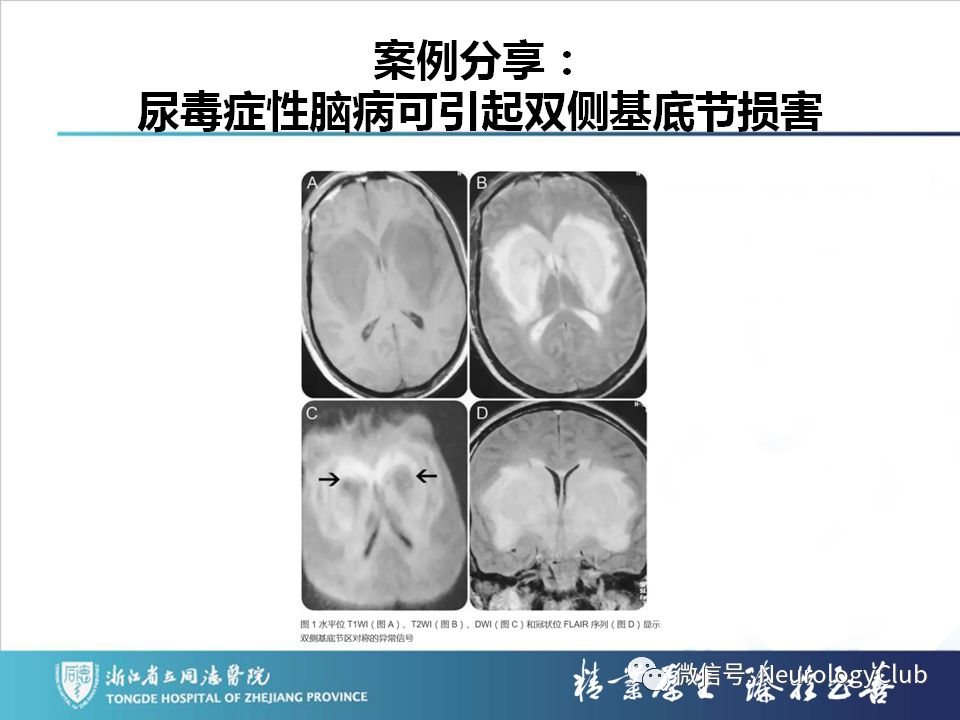 影像PPT - 【PPT】双侧基底节病变的影像诊断和鉴别诊断-187