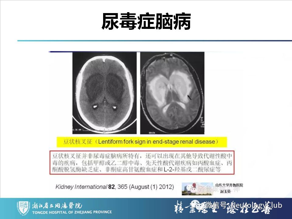 影像PPT - 【PPT】双侧基底节病变的影像诊断和鉴别诊断-188