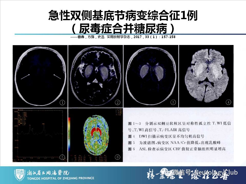 影像PPT - 【PPT】双侧基底节病变的影像诊断和鉴别诊断-189