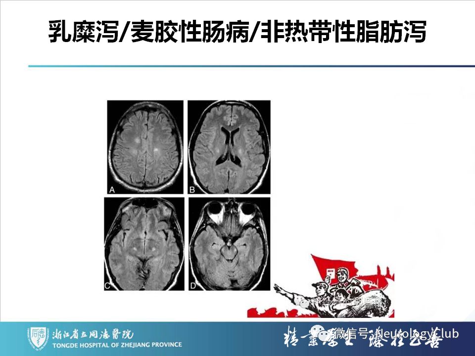 影像PPT - 【PPT】双侧基底节病变的影像诊断和鉴别诊断-194