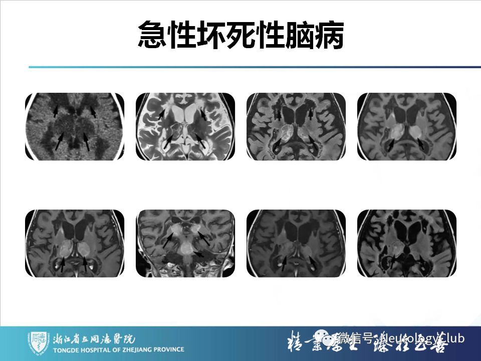 影像PPT - 【PPT】双侧基底节病变的影像诊断和鉴别诊断-197
