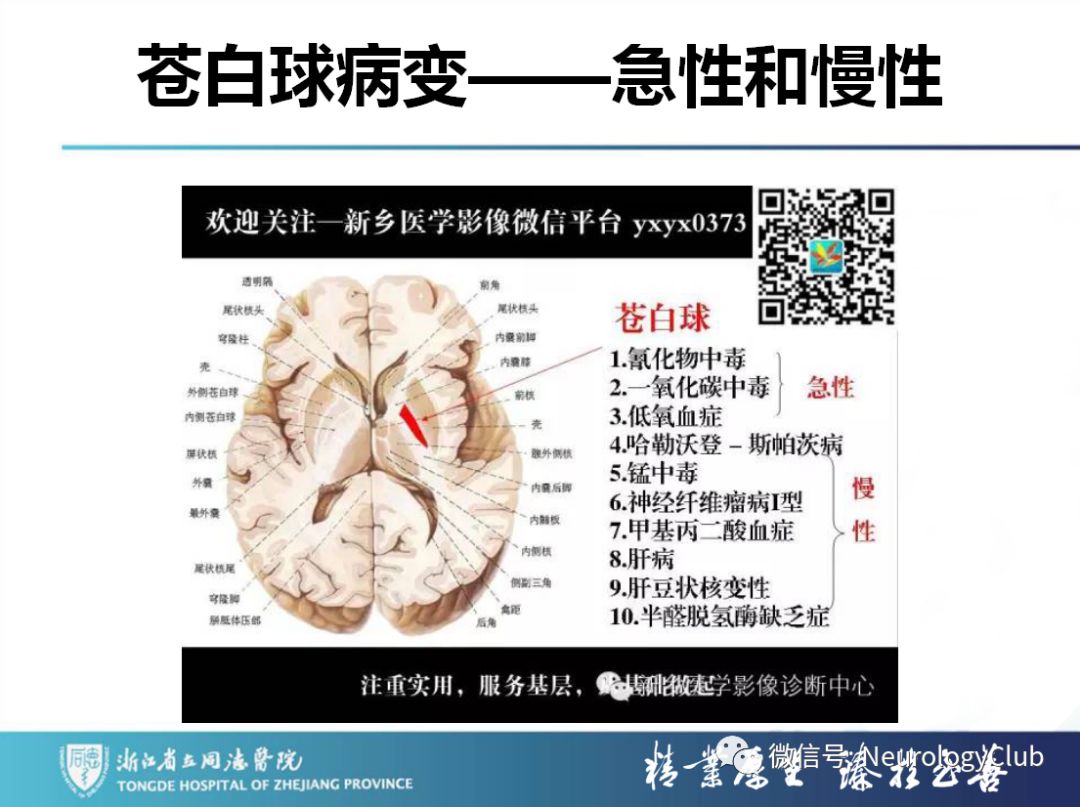 影像PPT - 【PPT】双侧基底节病变的影像诊断和鉴别诊断-216