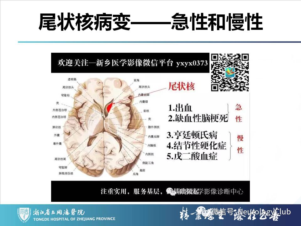 影像PPT - 【PPT】双侧基底节病变的影像诊断和鉴别诊断-219