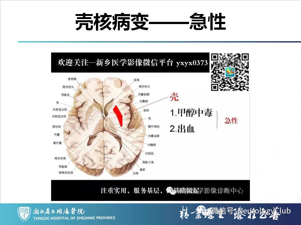 影像PPT - 【PPT】双侧基底节病变的影像诊断和鉴别诊断-220
