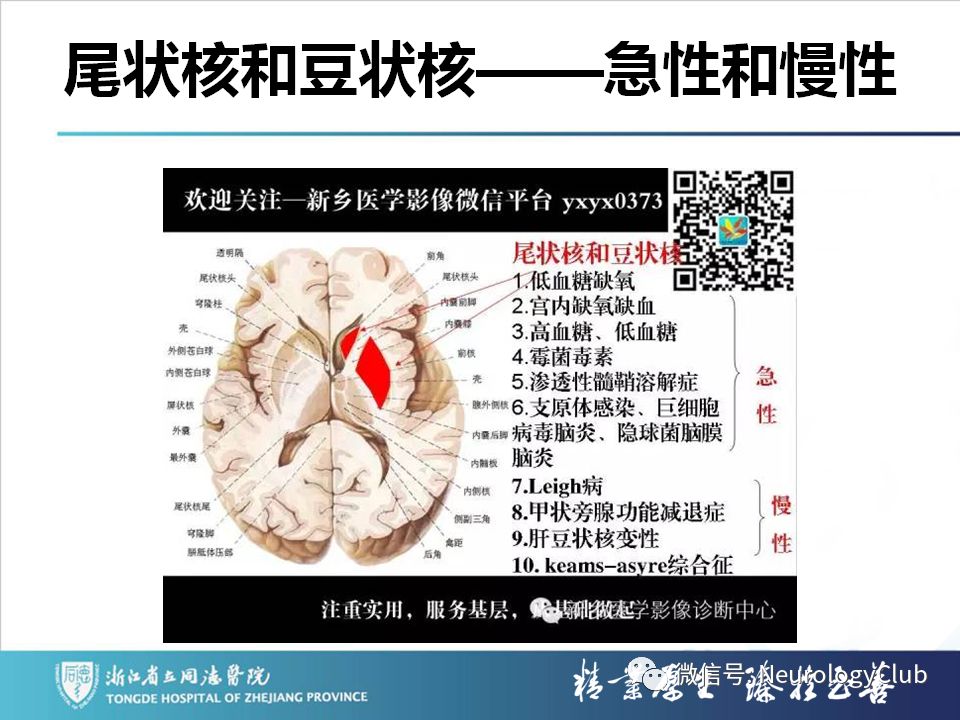 影像PPT - 【PPT】双侧基底节病变的影像诊断和鉴别诊断-221