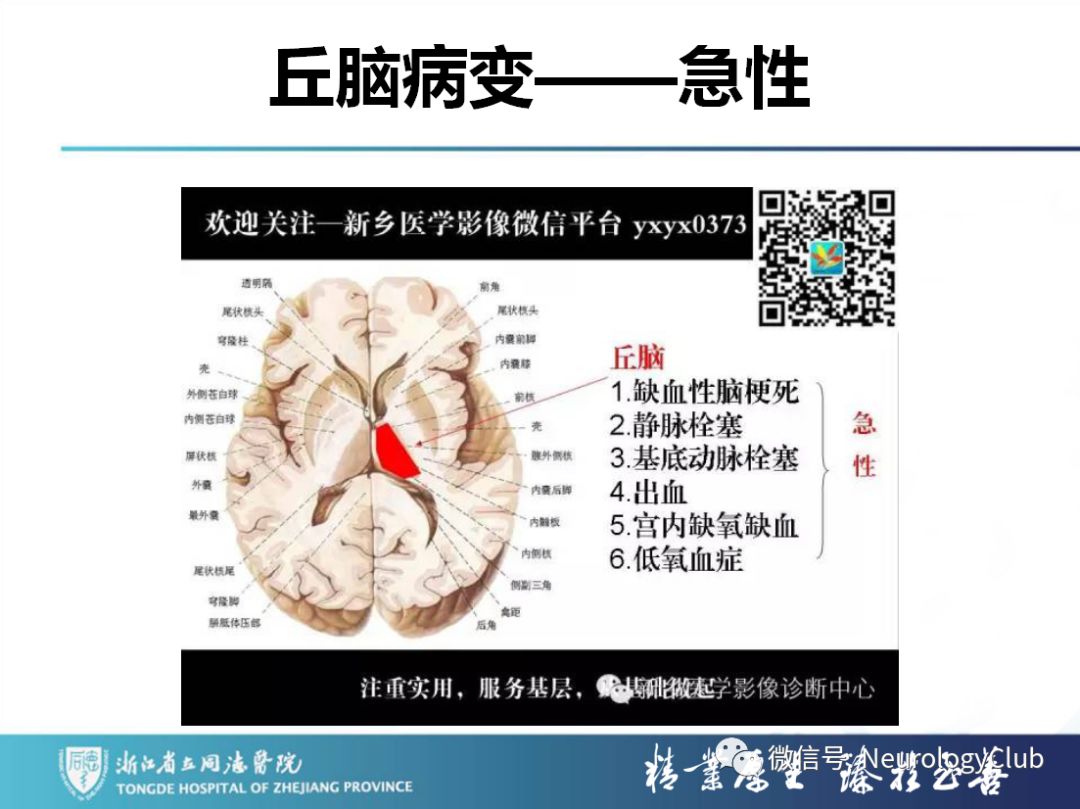 影像PPT - 【PPT】双侧基底节病变的影像诊断和鉴别诊断-223