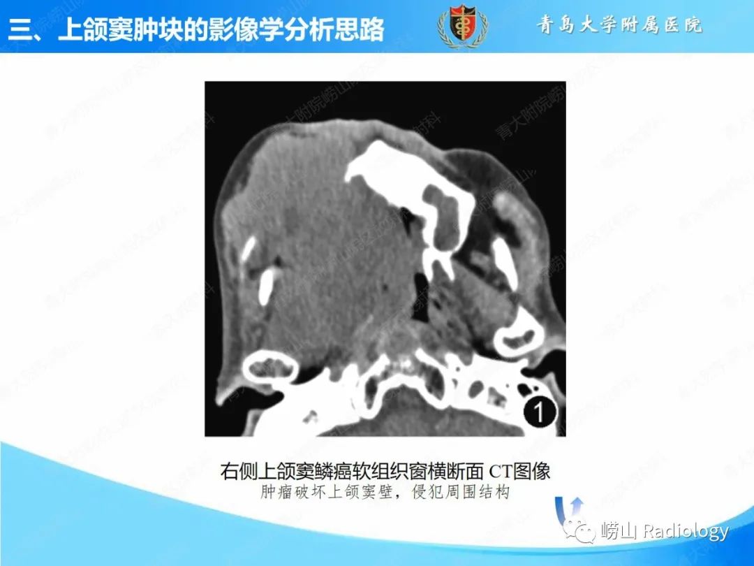 影像PPT - 【PPT】鼻腔鼻窦肿瘤和肿瘤样病变的影像学分析思路-10