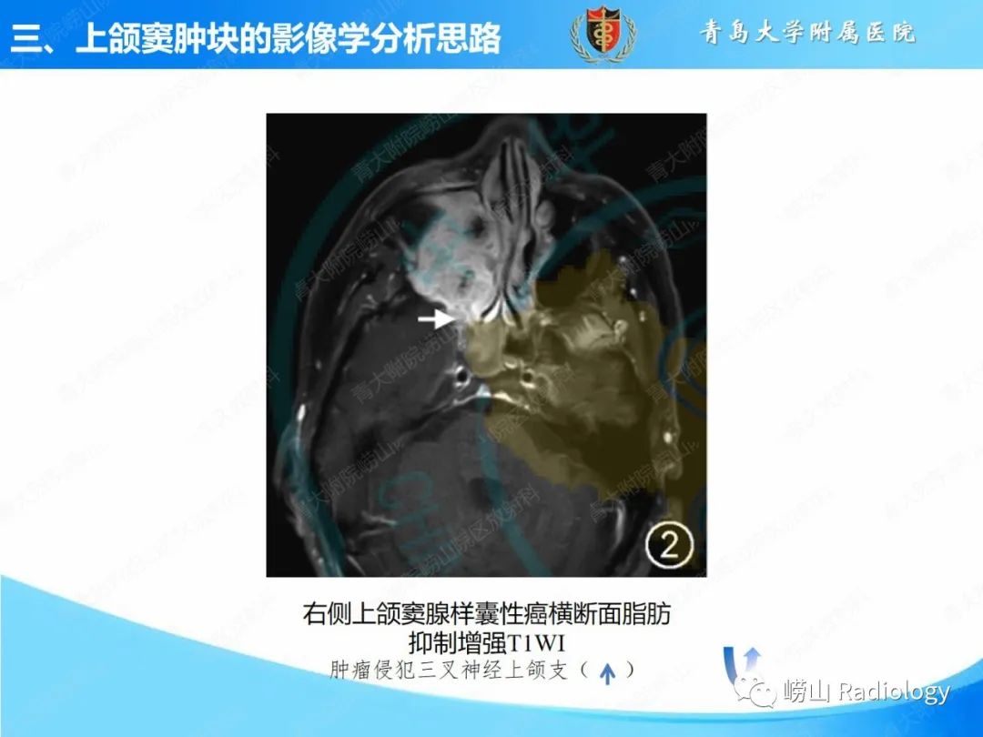 影像PPT - 【PPT】鼻腔鼻窦肿瘤和肿瘤样病变的影像学分析思路-11
