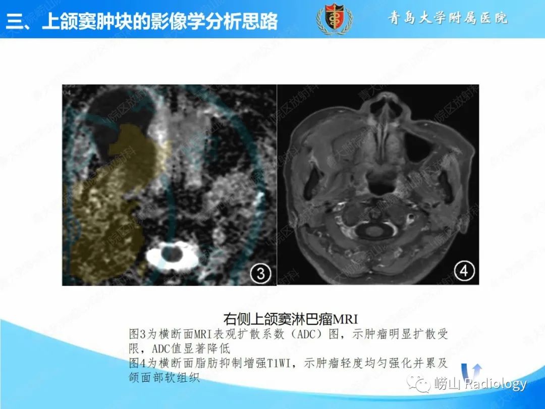 影像PPT - 【PPT】鼻腔鼻窦肿瘤和肿瘤样病变的影像学分析思路-12