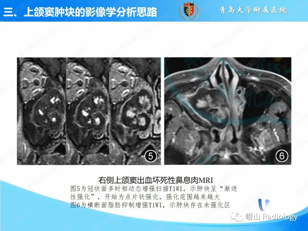 影像PPT - 【PPT】鼻腔鼻窦肿瘤和肿瘤样病变的影像学分析思路-13