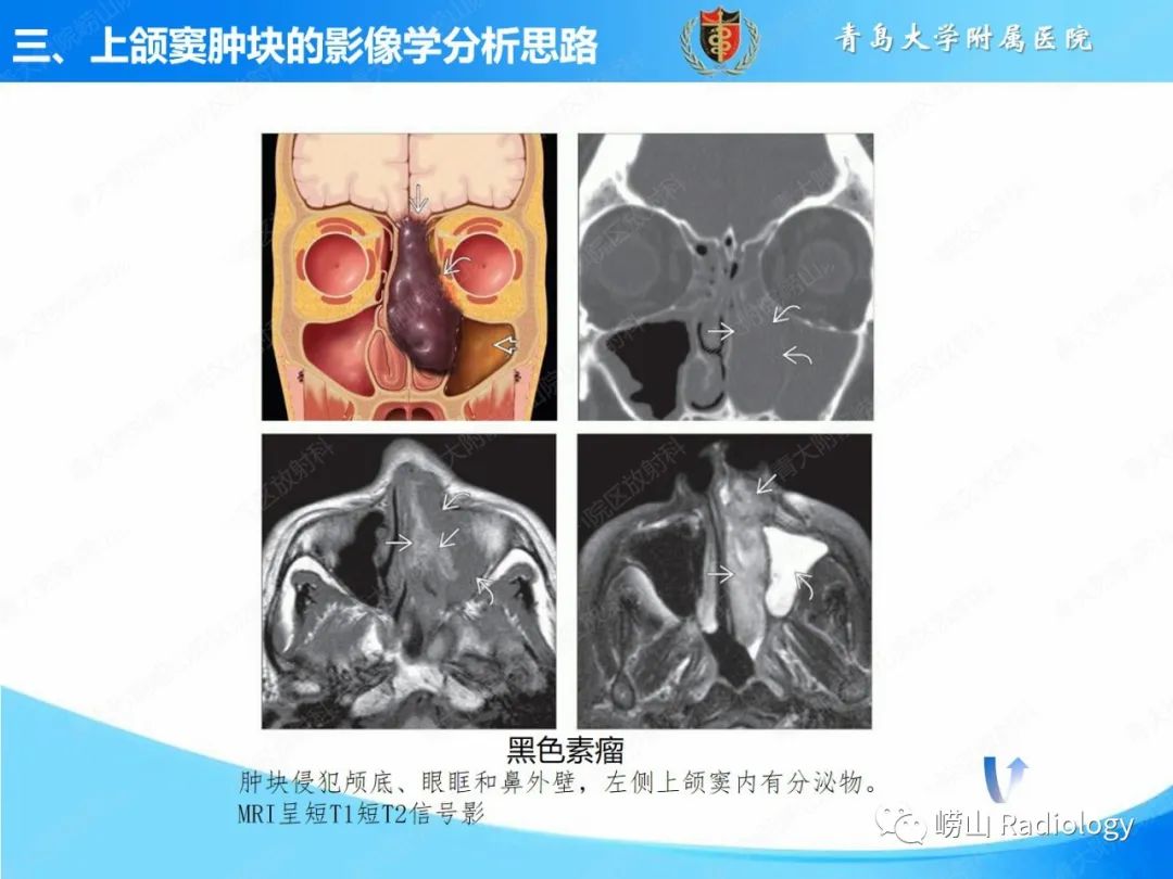 影像PPT - 【PPT】鼻腔鼻窦肿瘤和肿瘤样病变的影像学分析思路-14