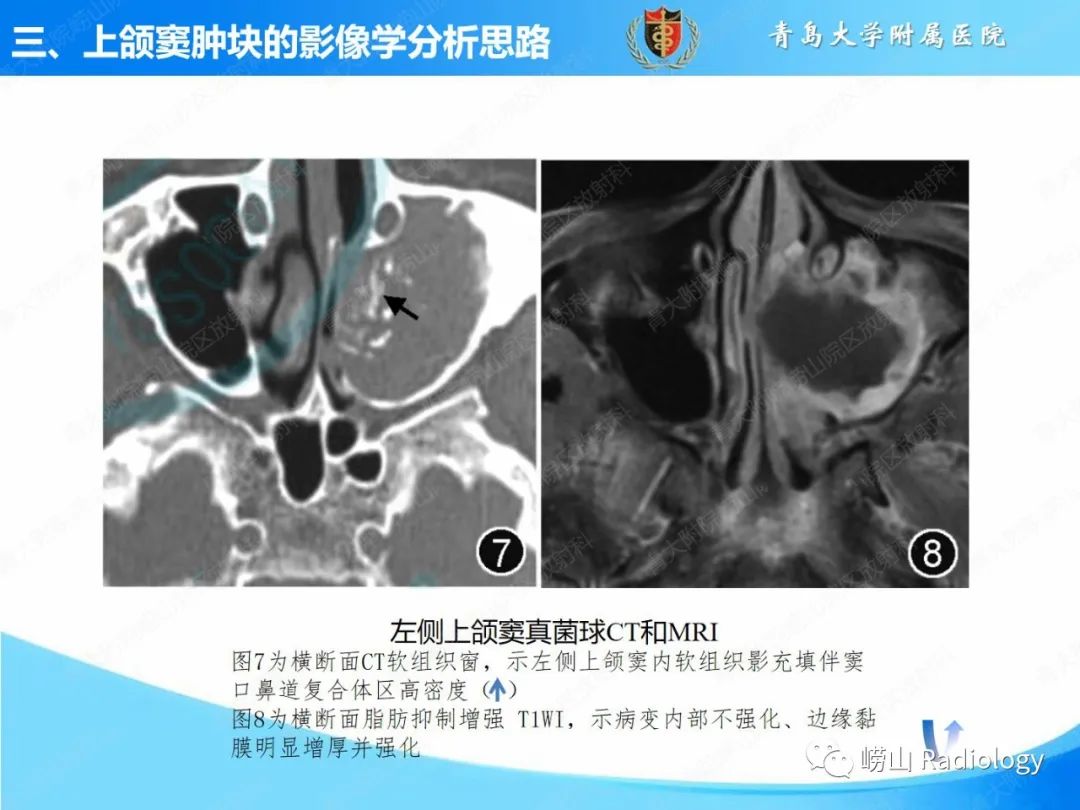 影像PPT - 【PPT】鼻腔鼻窦肿瘤和肿瘤样病变的影像学分析思路-16