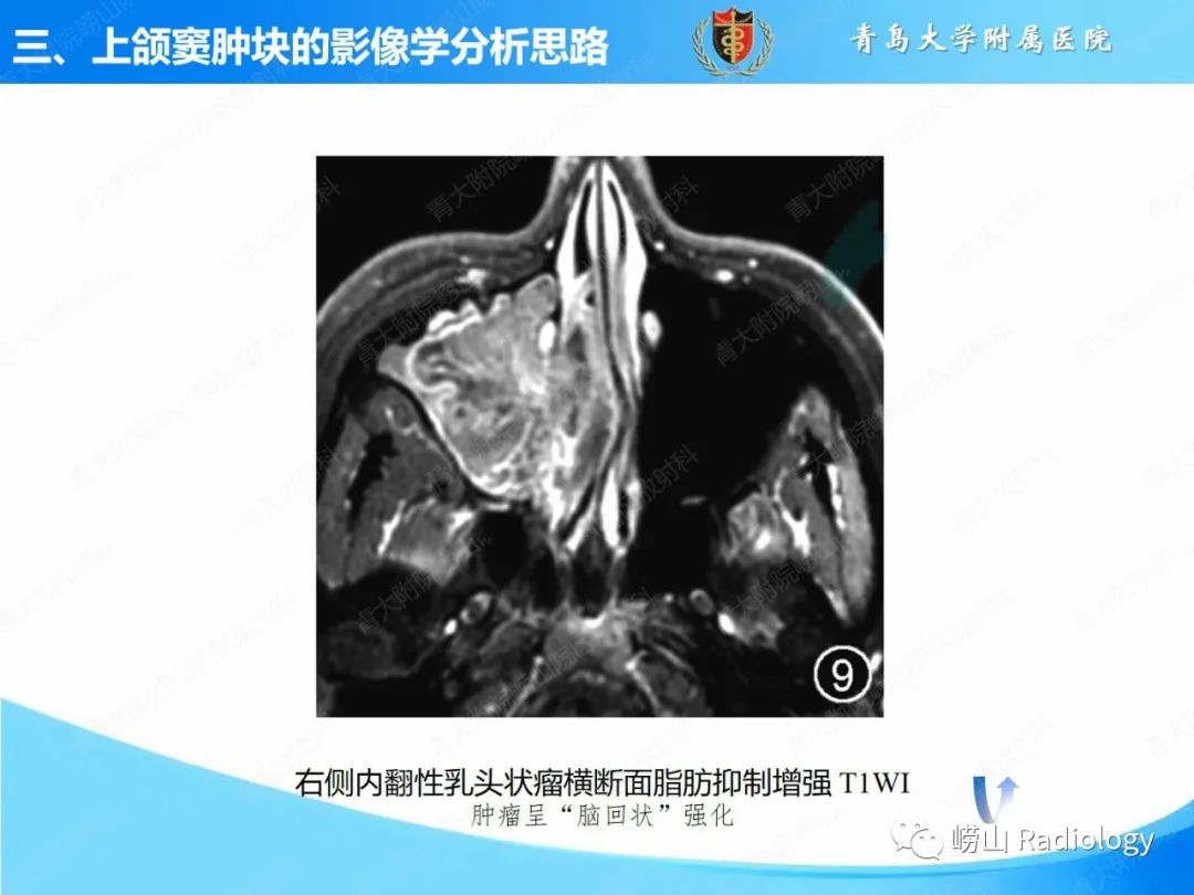 影像PPT - 【PPT】鼻腔鼻窦肿瘤和肿瘤样病变的影像学分析思路-17