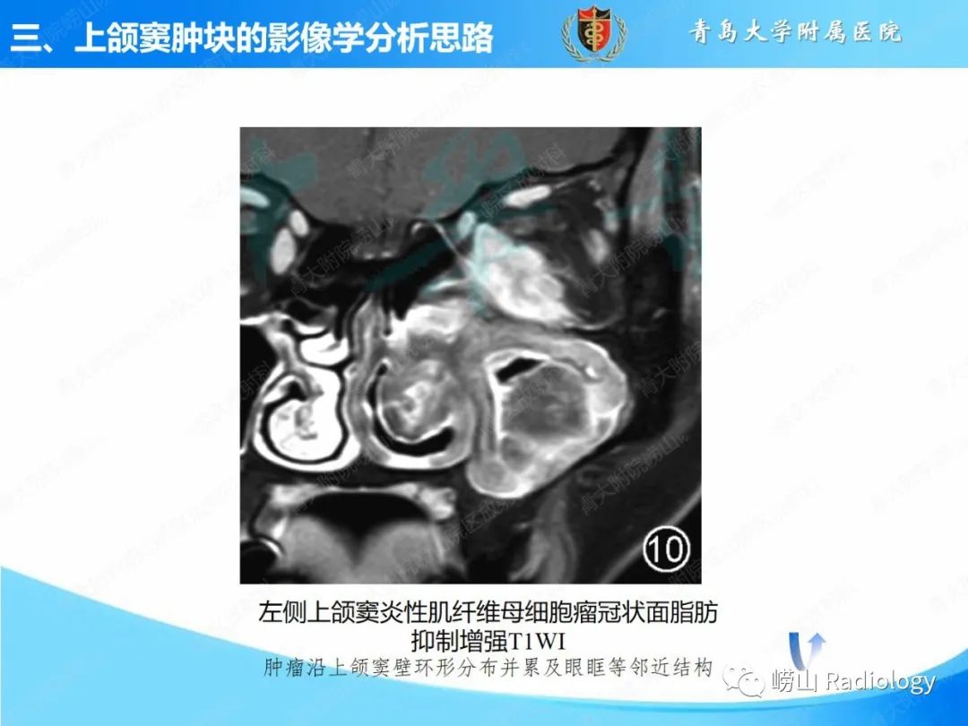 影像PPT - 【PPT】鼻腔鼻窦肿瘤和肿瘤样病变的影像学分析思路-18