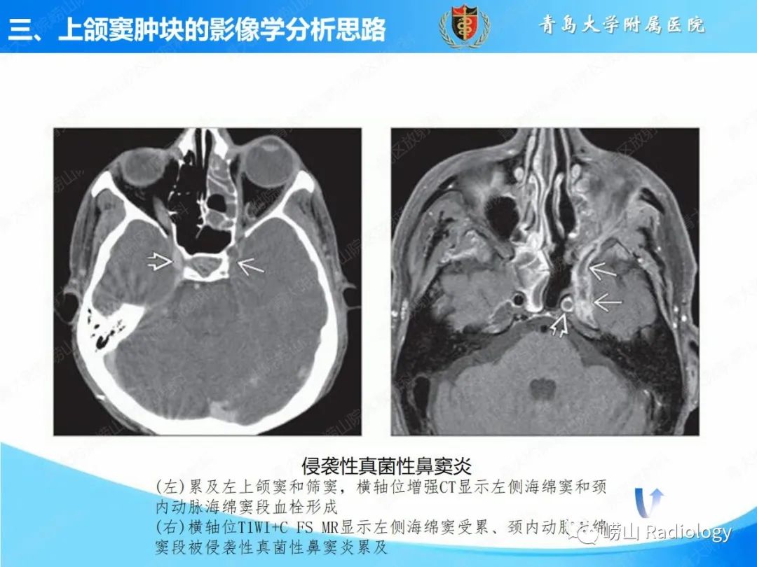 影像PPT - 【PPT】鼻腔鼻窦肿瘤和肿瘤样病变的影像学分析思路-19