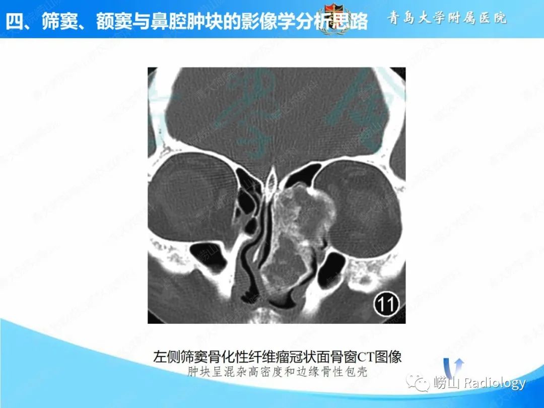 影像PPT - 【PPT】鼻腔鼻窦肿瘤和肿瘤样病变的影像学分析思路-26